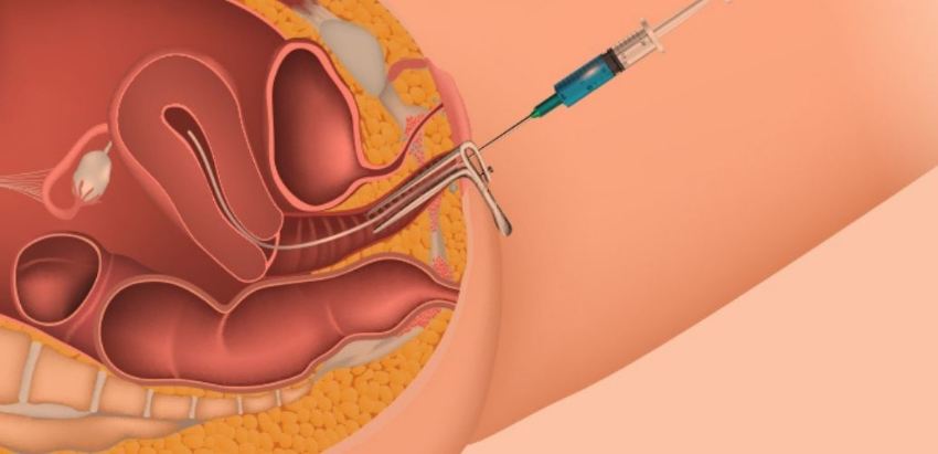 IUI (Intrauterine Insemination)